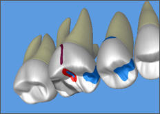 3 restorations and crack-3D