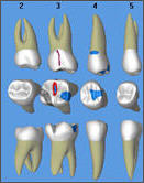 3 restorations and crack